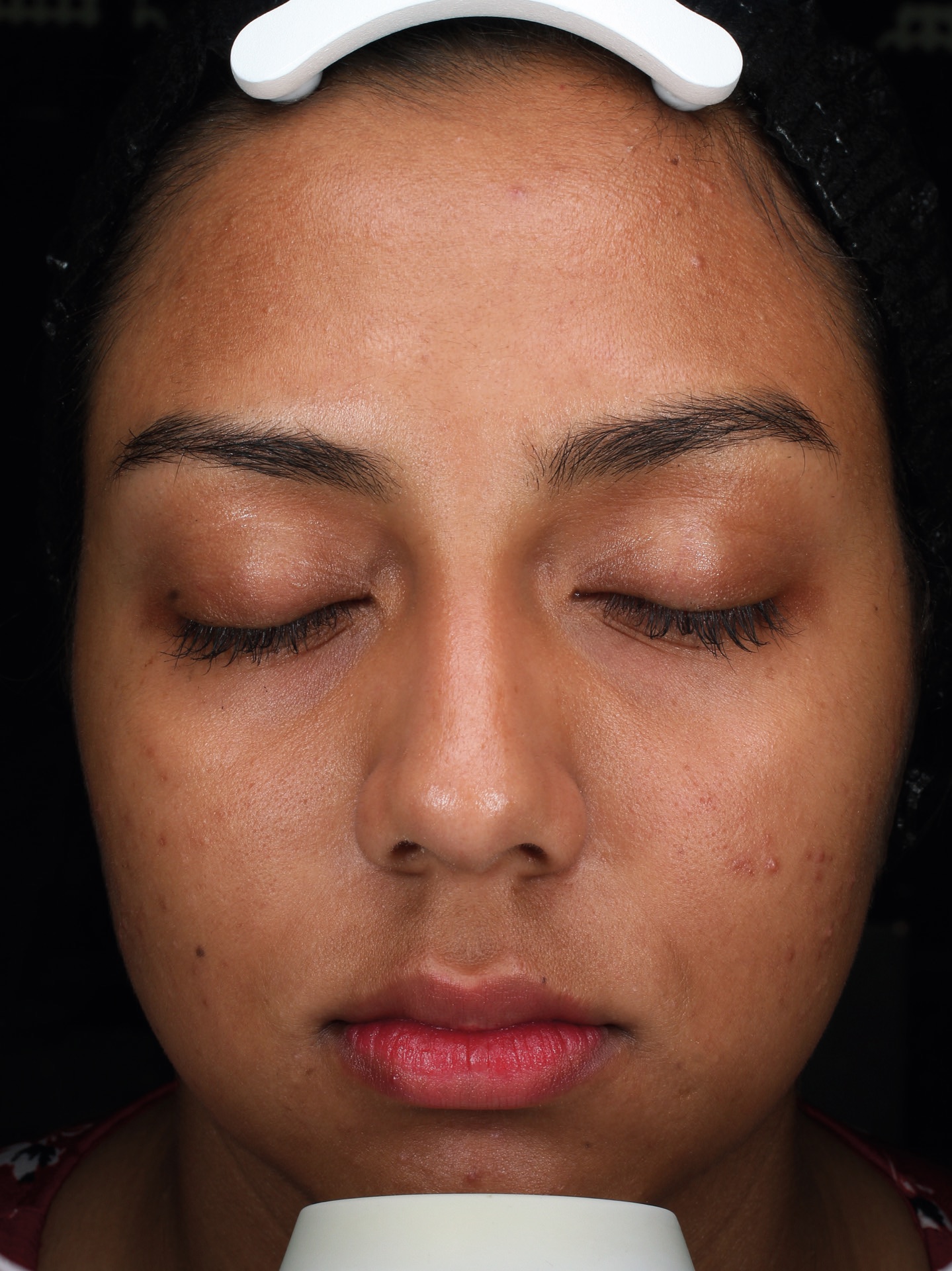 The same skin after the CLEARIST CTX protocol